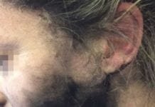 Mulher tem rosto queimado por fone de ouvido durante voo