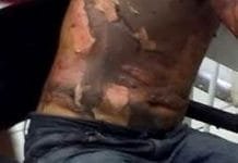 Mulher coloca fogo no marido dormindo por ciúmes de outro homem