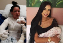 Universitária rondoniense que sofreu queimaduras em churrasco morre em hospital