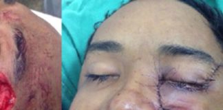 Estudante tem o rosto desfigurado por touro de 300 kg durante treino de montaria em Rondônia