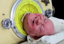 Homem que viveu com pulmão de ferro por 70 anos morre de covid
