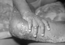 É questão de tempo, diz médico sobre disseminação de Mpox pelo mundo