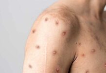 Prefeitura de Jaru orienta população em casos de suspeita de Mpox