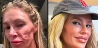 Influenciadora diz ter procurado 21 médicos após ‘derretimento facial’